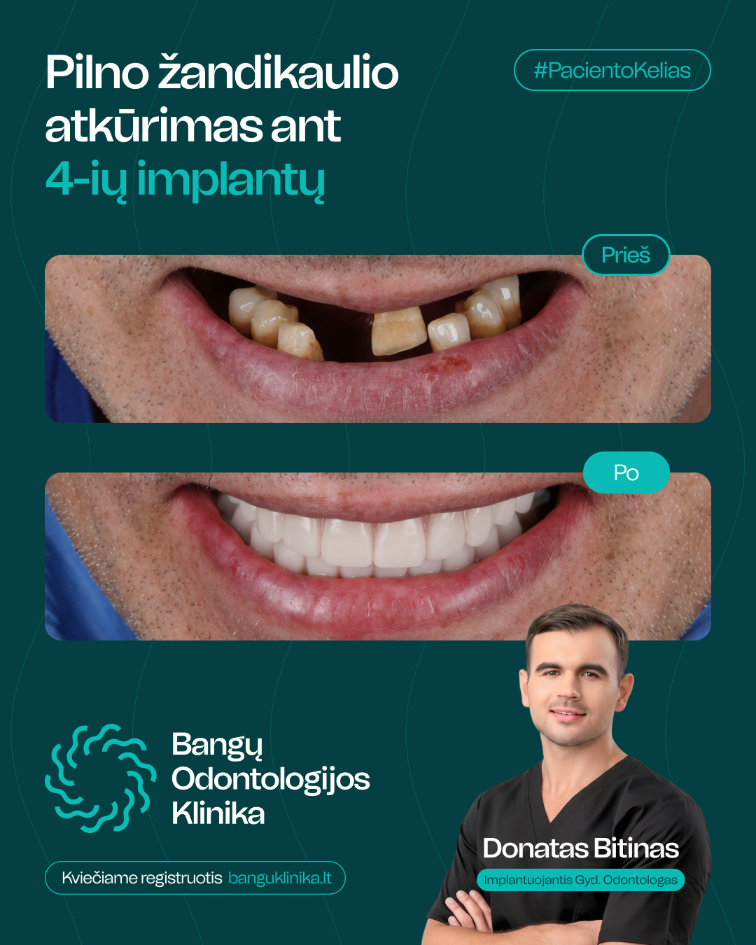 ALL-ON-4 implantacija