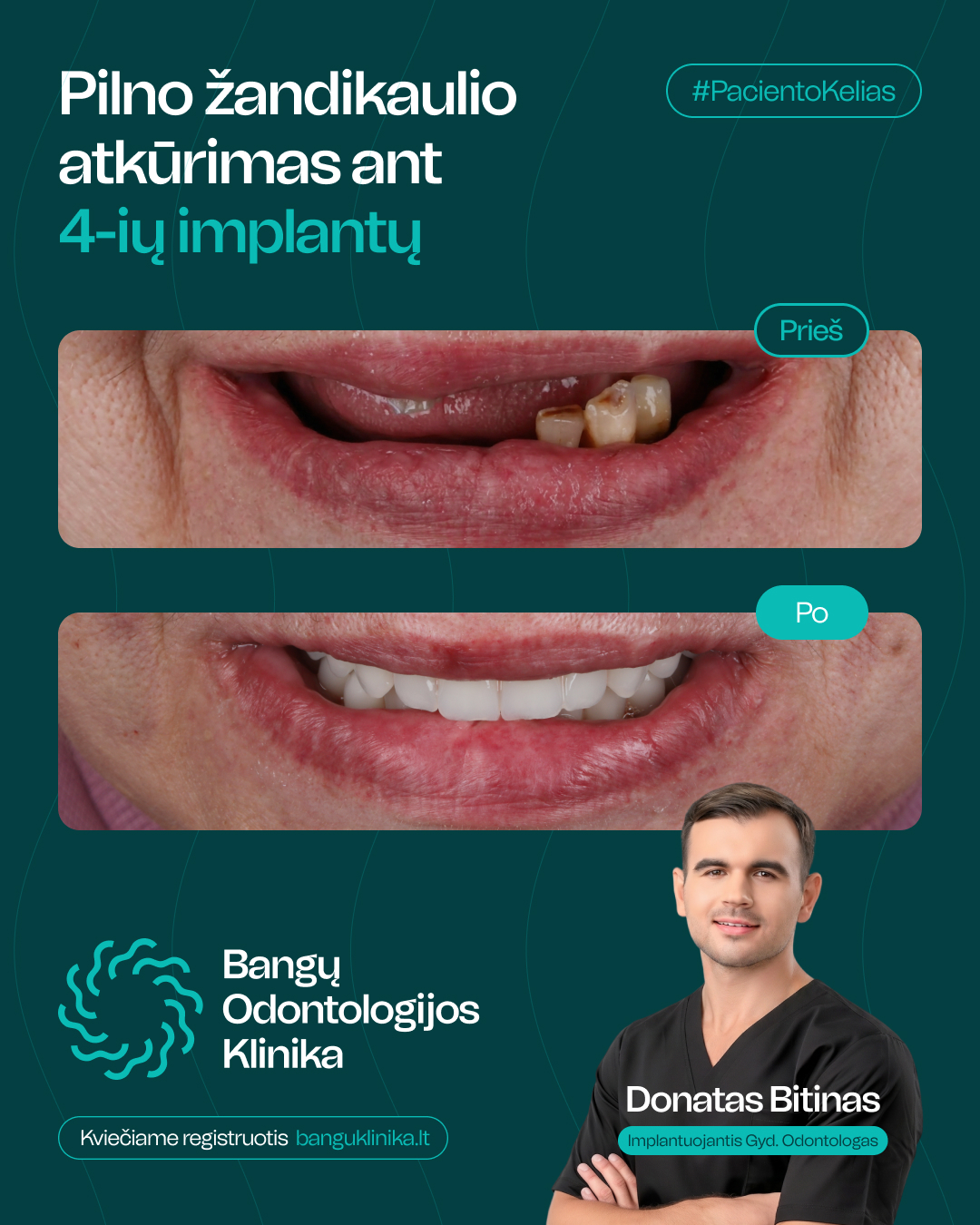 All-on-4 implantācija — pirms un pēc