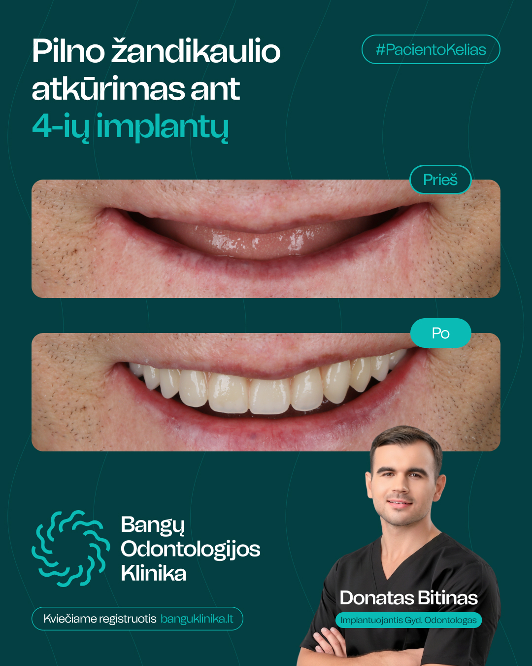 All-on-4 implantācija — pirms un pēc