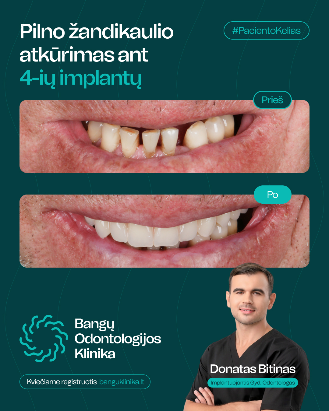 All-on-4 implantācija — pirms un pēc